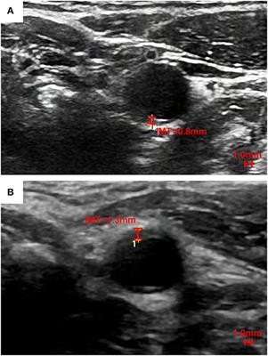 The Predictive Value of Carotid Ultrasonography With Cardiovascular Risk Factors—A “SPIDER” Promoting Atherosclerosis